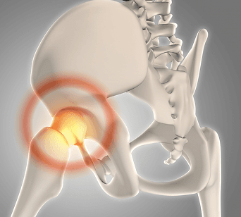 PERSONALIZED 3D HIP REPLACEMENT